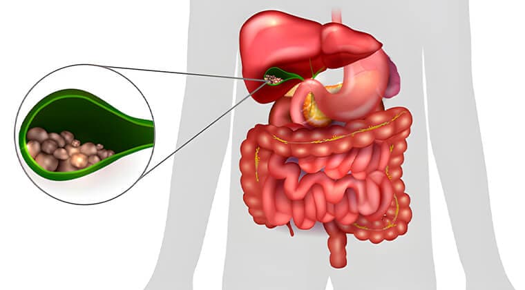 Colecistitis y cálculos biliares