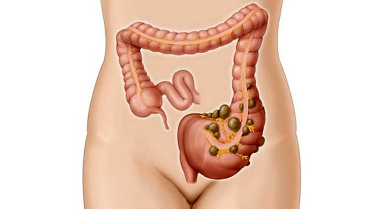 Diverticulitis aguda