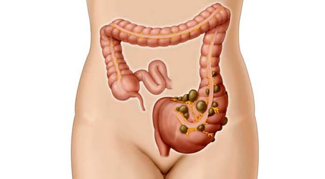 Diverticulitis aguda