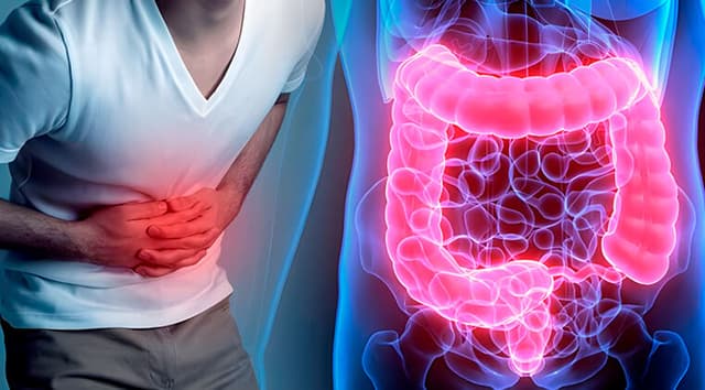 Enfermedad inflamatoria intestinal