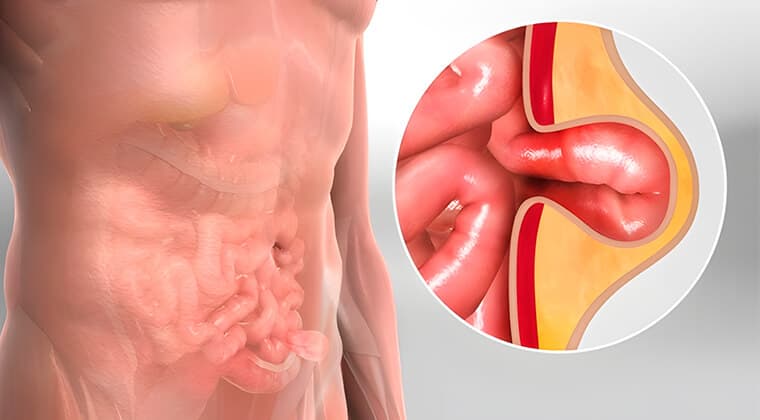 Hernias abdominales, inguinales y umbilicales
