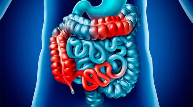 Obstrucción intestinal