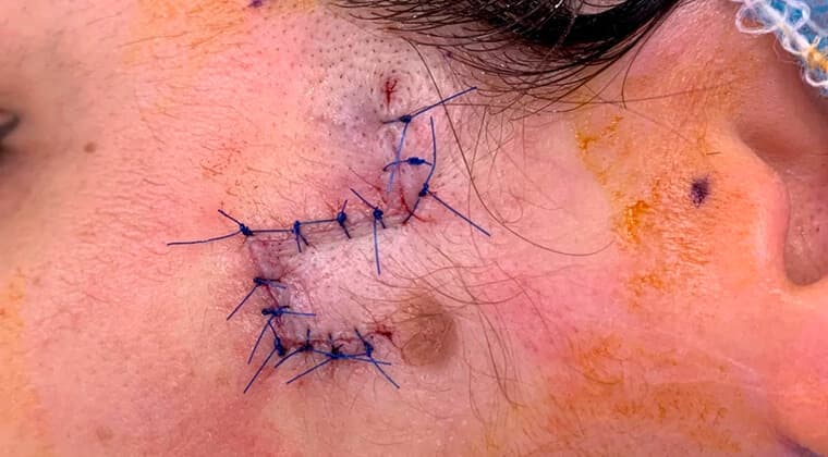 Cirugía de cáncer de piel con reconstrucción