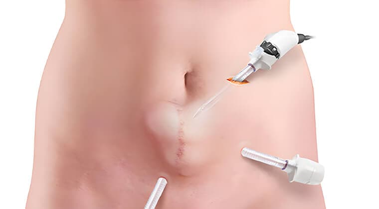 Reparación de hernias
