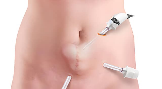 Reparación de hernias