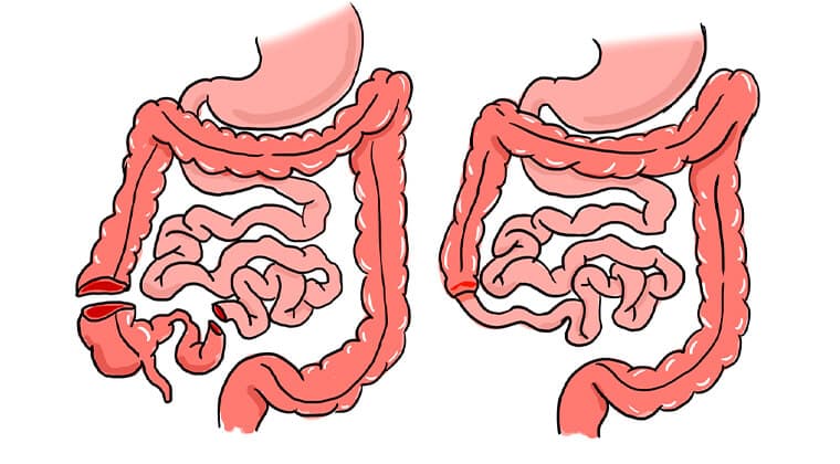 Resecciones intestinales