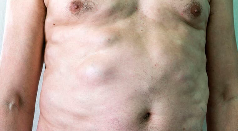 Bulto doloroso en ingle o abdomen